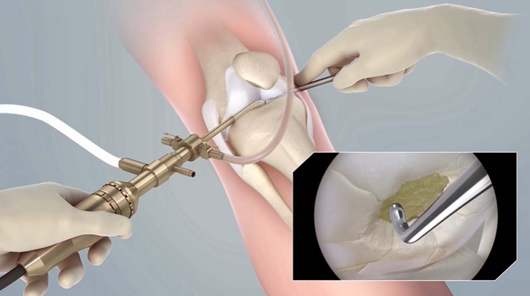 lesión de cartilago en la rodilla - daño condral