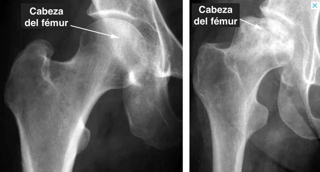 Radiografía de una necrosis avascular u osteonecrosis de la cabeza del fémur