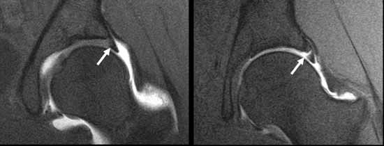 Resonancia magnética de un labrum de cadera normal (izquierda) y un labrum desgarrado o roto (derecha).