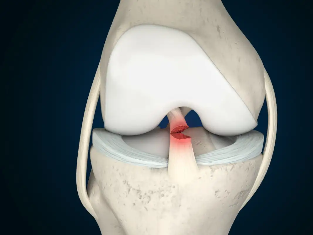 lesion-de-ligamento-cruzado